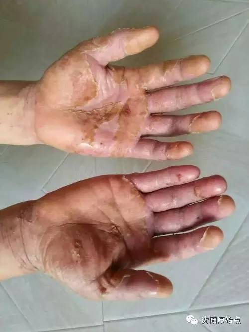 30年顽固湿疹15天痊愈 30年顽固湿疹15天痊愈