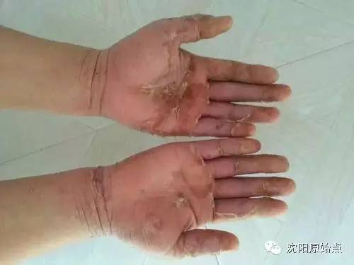 30年顽固湿疹15天痊愈 30年顽固湿疹15天痊愈