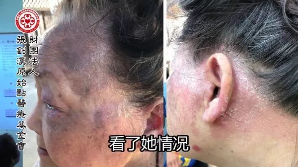 牛皮癣案例（美国 南湾Grace）-原始点全球同学网