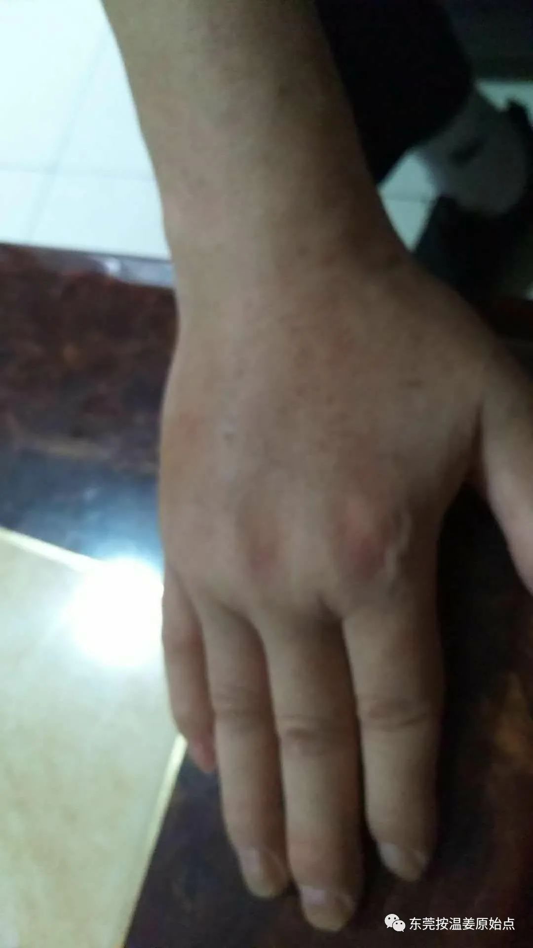 脑梗中风五年后遗症