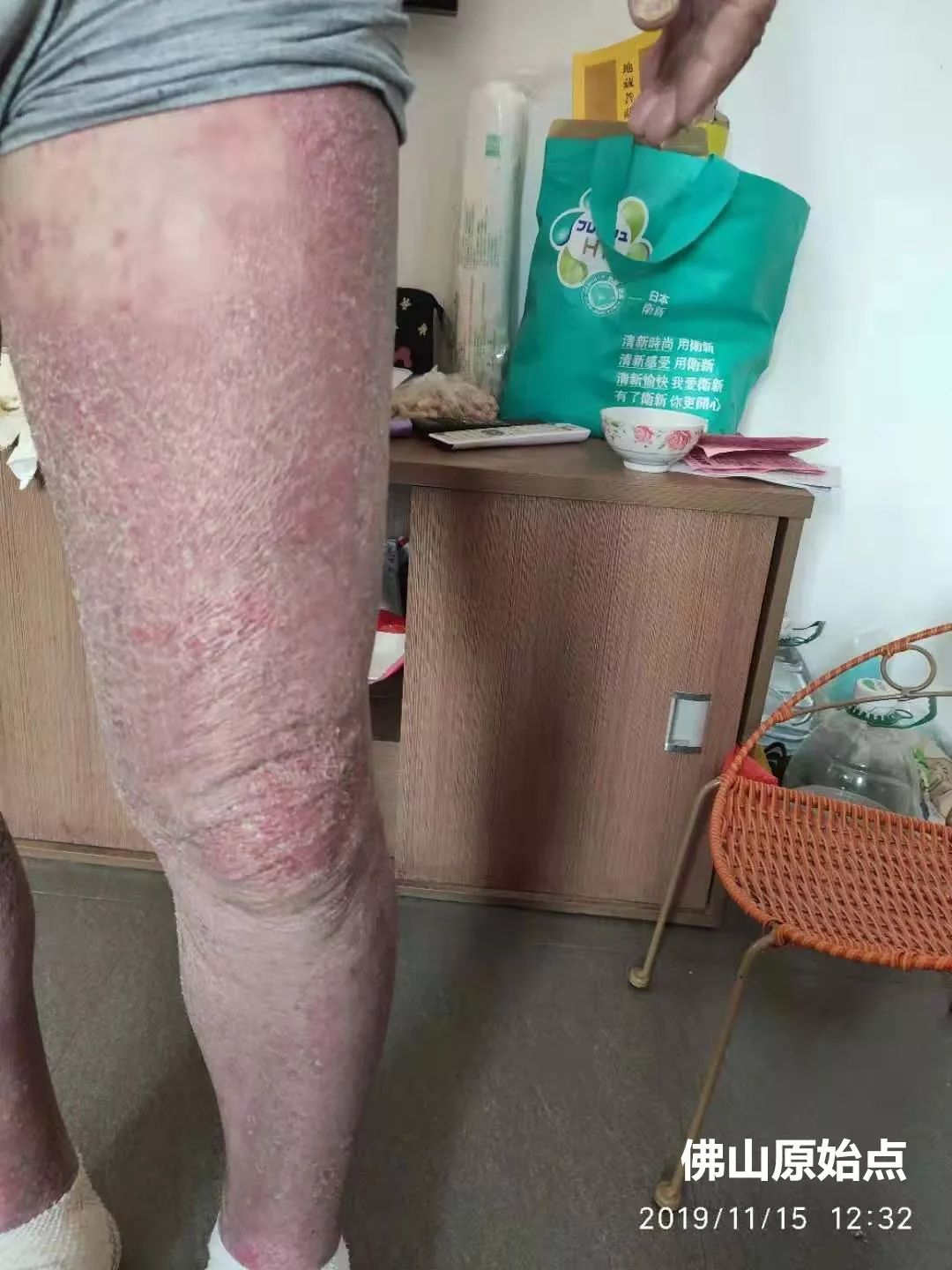 原始点调理十年牛皮癣案例 原始点调理十年牛皮癣案例