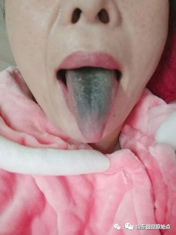 带状疱疹案例 30年顽固湿疹 便秘、肚子痛被折腾到接近命危案例 带状疱疹案例 30年顽固湿疹 便秘、肚子痛被折腾到接近命危案例