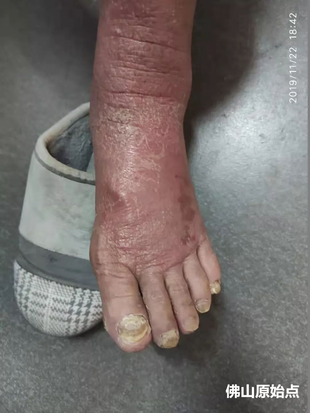 原始点调理十年牛皮癣案例 原始点调理十年牛皮癣案例