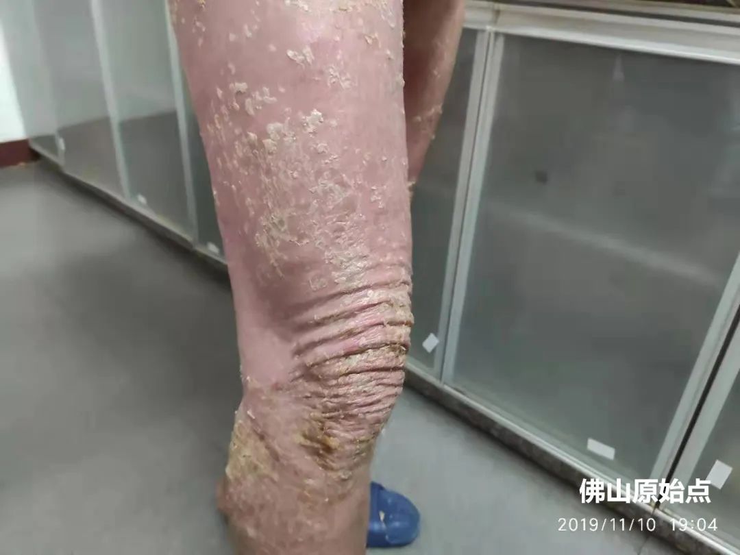 原始点调理十年牛皮癣案例 原始点调理十年牛皮癣案例