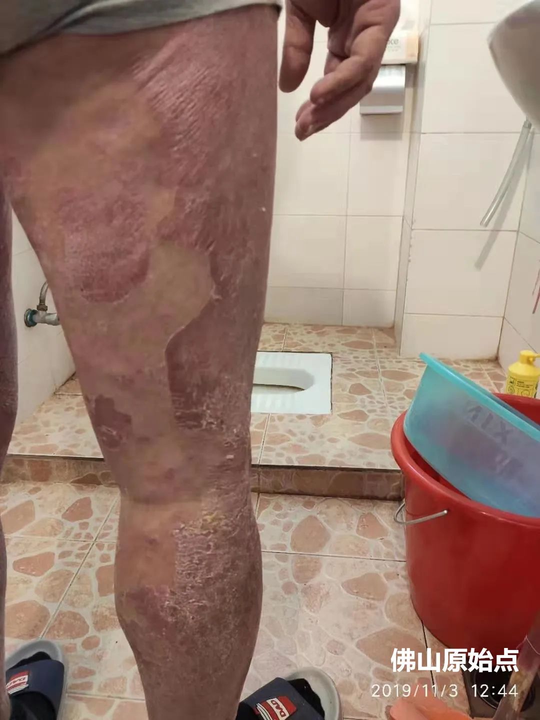 原始点调理十年牛皮癣案例 原始点调理十年牛皮癣案例