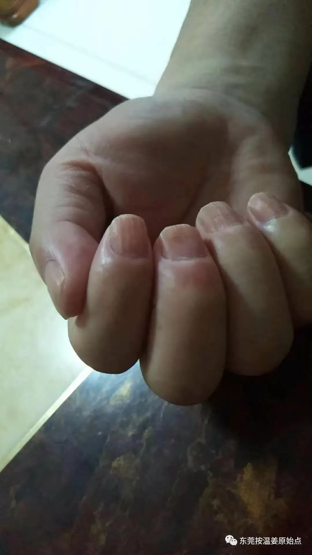 脑梗中风五年后遗症