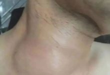 30多年甲亢案例！-原始点全球同学网