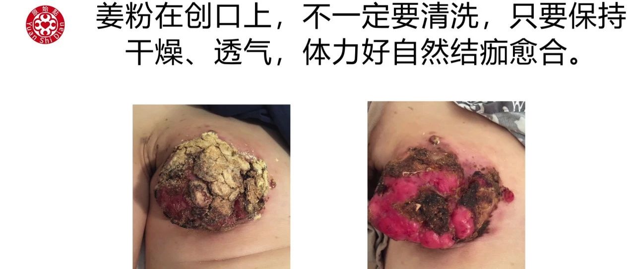 乳癌处理解说-原始点全球同学网