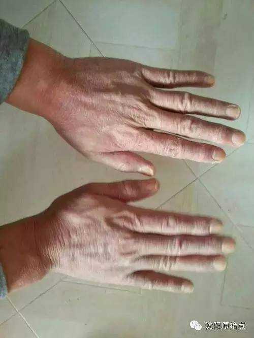 带状疱疹案例 30年顽固湿疹 便秘、肚子痛被折腾到接近命危案例 带状疱疹案例 30年顽固湿疹 便秘、肚子痛被折腾到接近命危案例