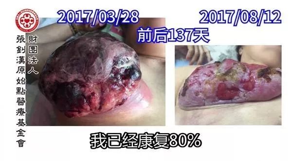 乳癌案例（马来西亚）--2017.11最新案例-原始点全球同学网