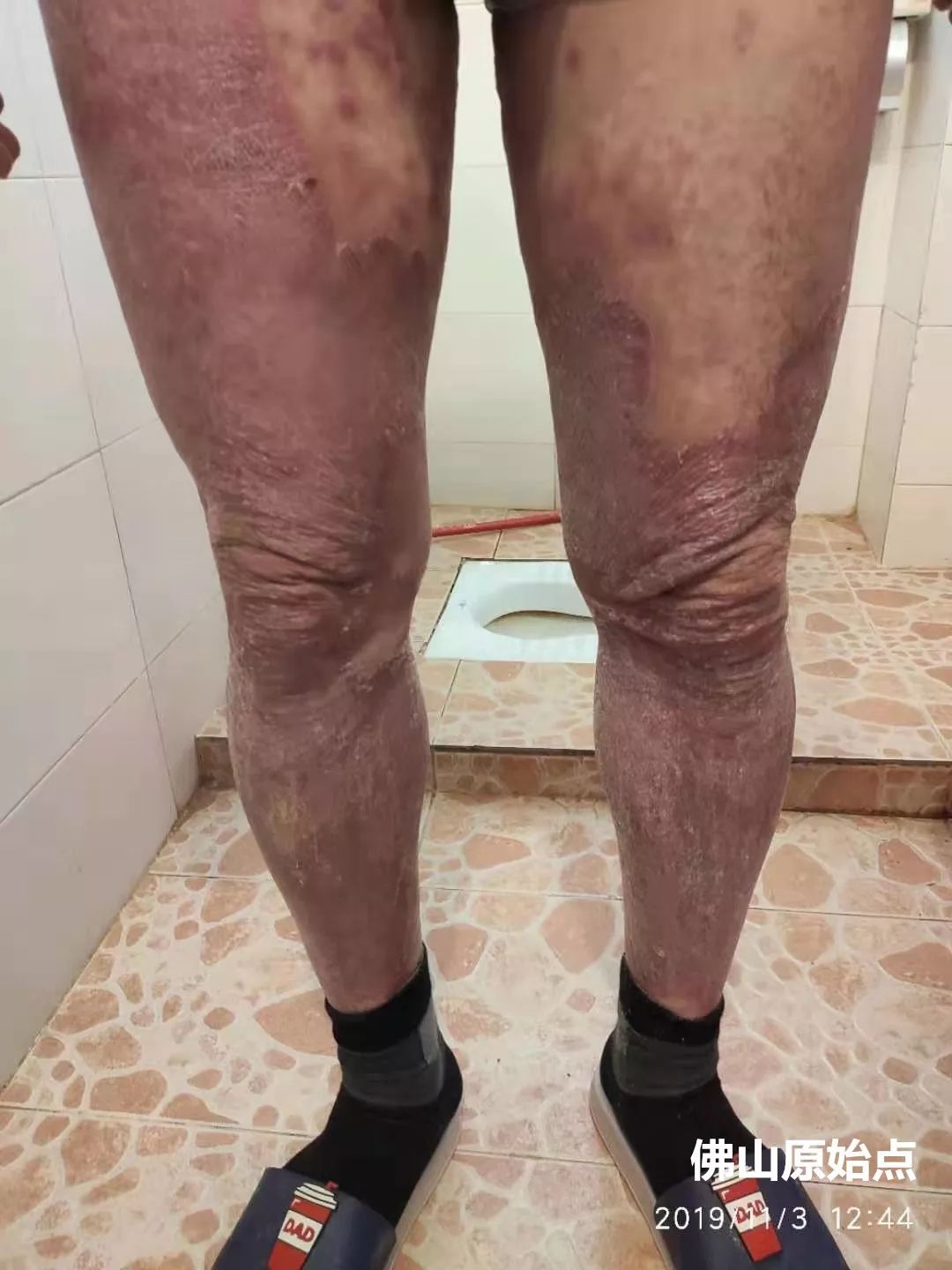 原始点调理十年牛皮癣案例 原始点调理十年牛皮癣案例