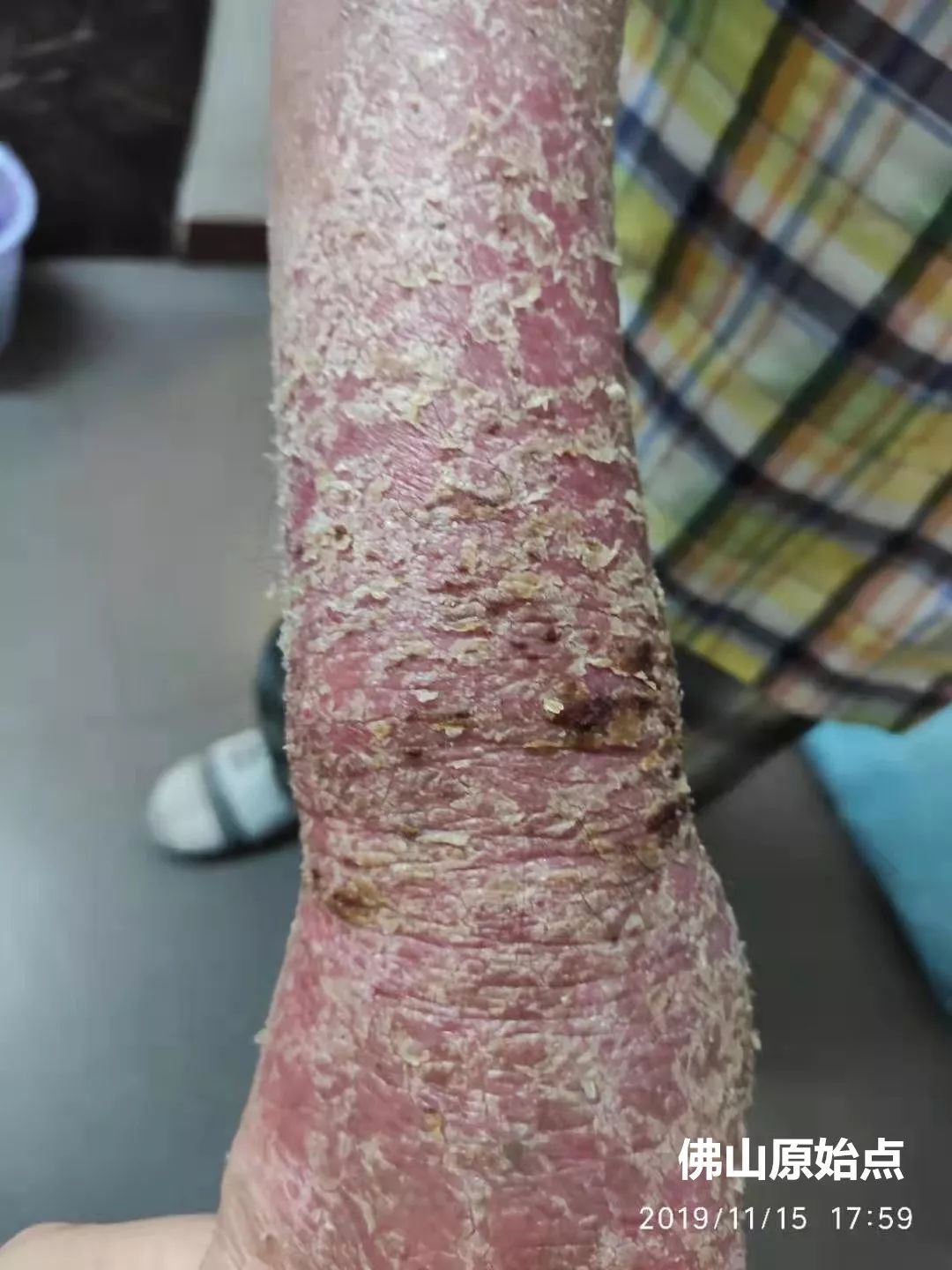 原始点调理十年牛皮癣案例 原始点调理十年牛皮癣案例