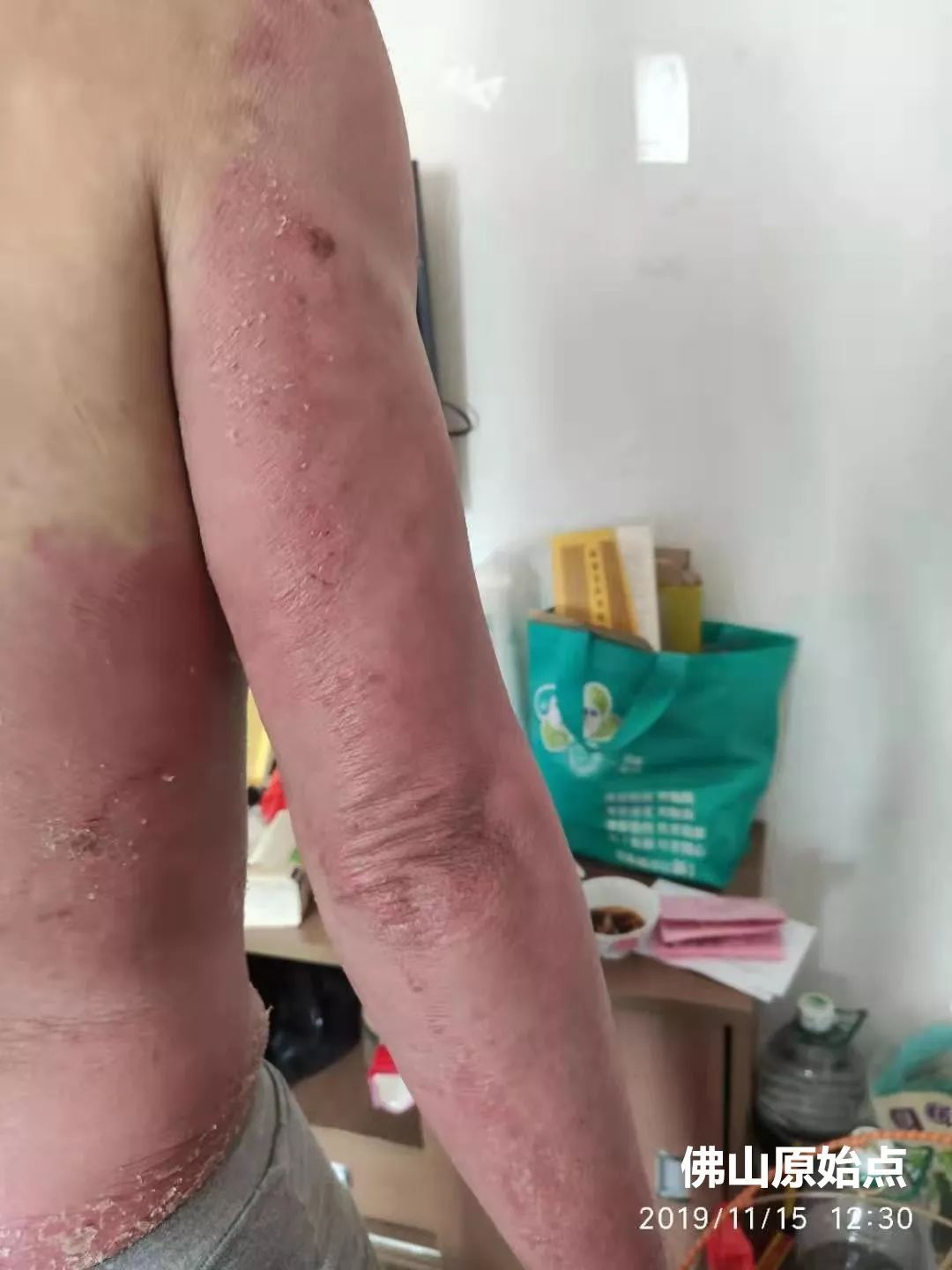 原始点调理十年牛皮癣案例 原始点调理十年牛皮癣案例