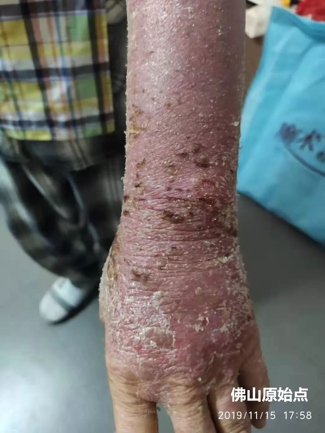 原始点调理十年牛皮癣案例 原始点调理十年牛皮癣案例