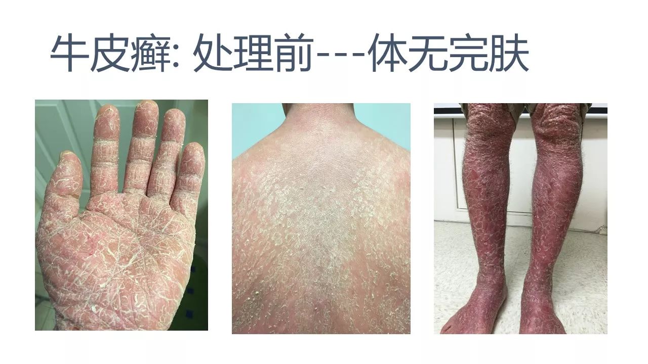 牛皮癣案例(日本人)(后续追踪)(字幕版) 牛皮癣案例(日本人)(后续追踪)(字幕版)