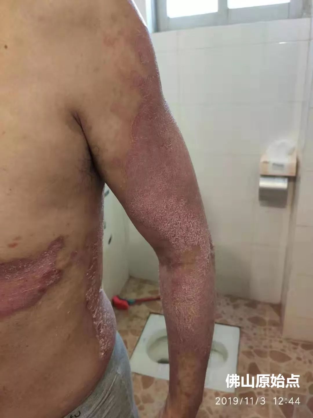 原始点调理十年牛皮癣案例 原始点调理十年牛皮癣案例