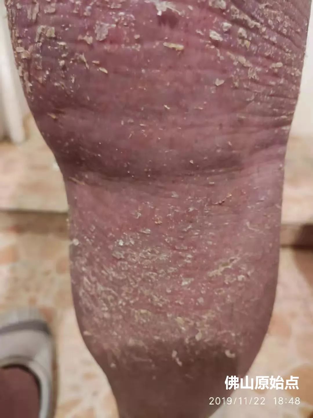 原始点调理十年牛皮癣案例 原始点调理十年牛皮癣案例