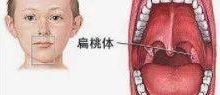 扁桃体摘除手术后的风险-原始点全球同学网
