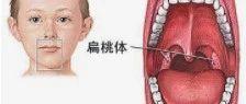 扁桃体摘除手术后的风险-原始点全球同学网