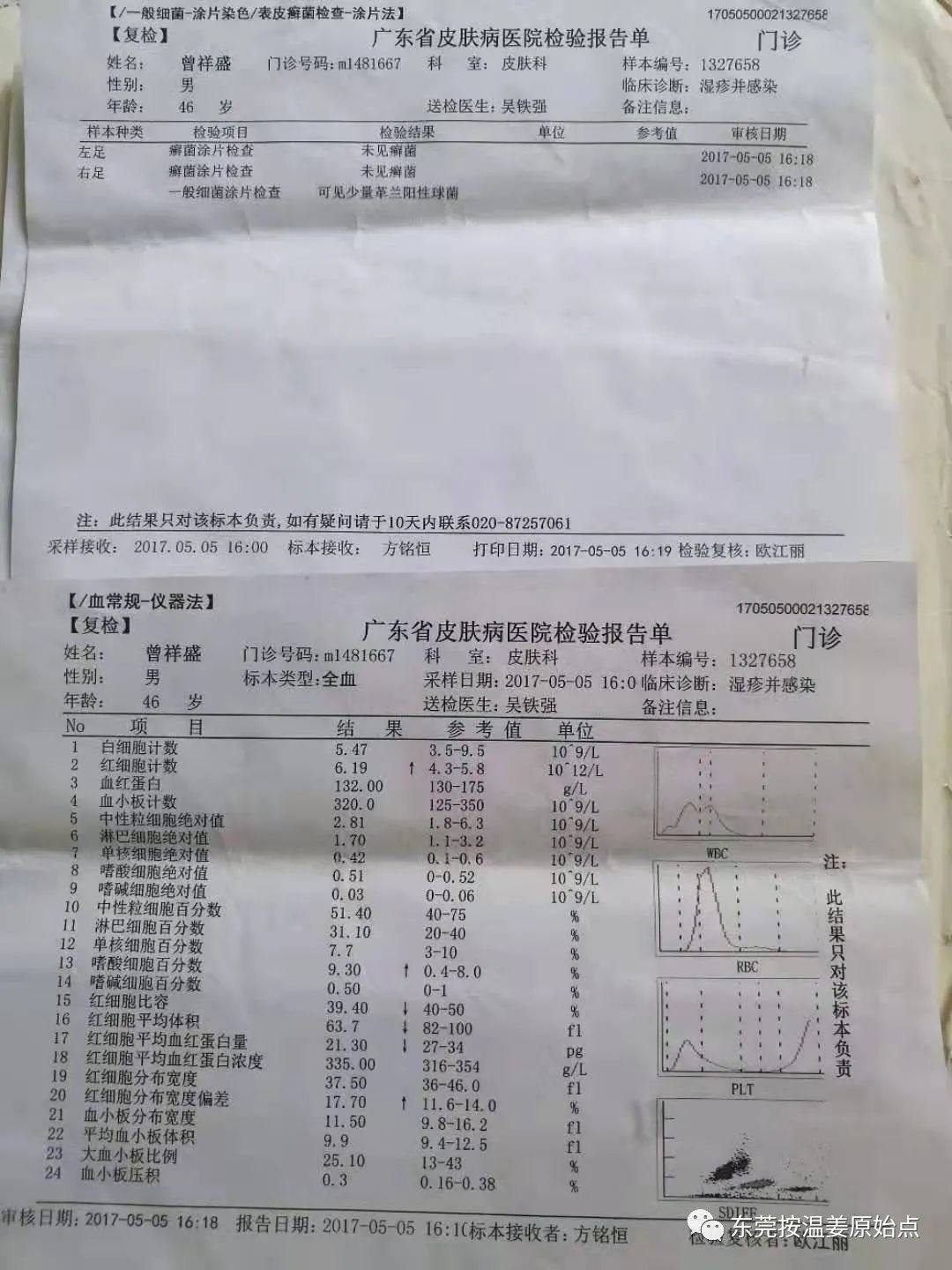 严重湿疹,真菌感染 严重湿疹,真菌感染