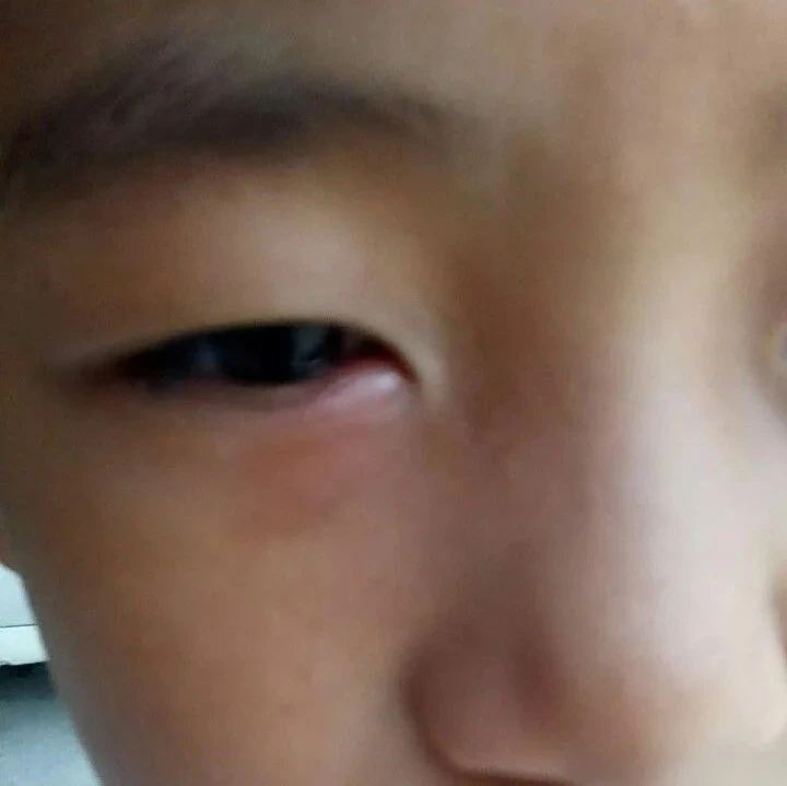 小孩眼睛红肿，耳朵痛，用原始点自己处理-原始点全球同学网