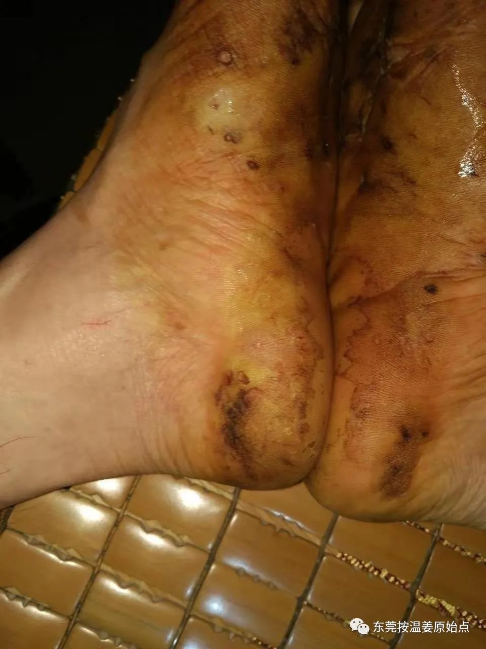 严重湿疹,真菌感染 严重湿疹,真菌感染