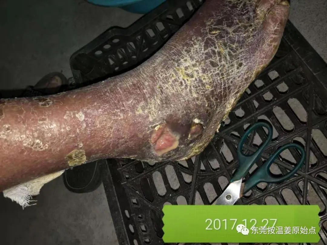 原始点让87岁中风的老爷爷免除截肢,重新行走 原始点让87岁中风的老爷爷免除截肢,重新行走