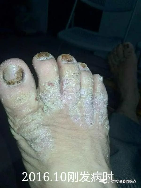 严重湿疹,真菌感染 严重湿疹,真菌感染