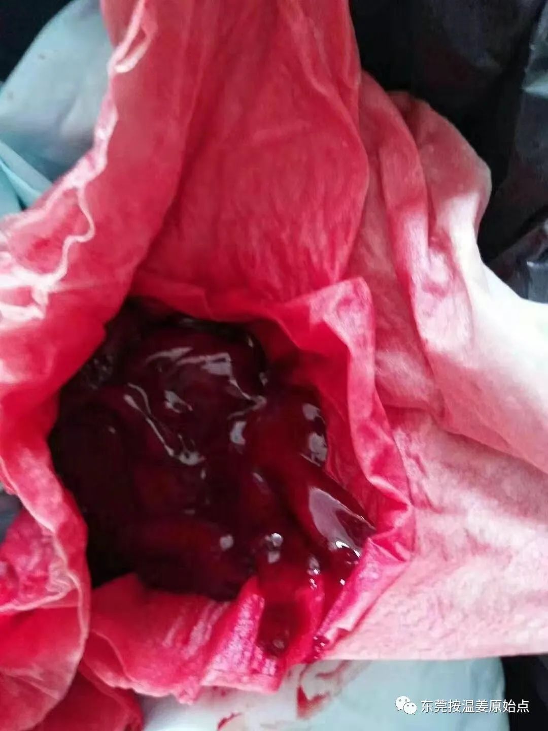 用原始点排出死胎,免除刮宫手术 用原始点排出死胎,免除刮宫手术