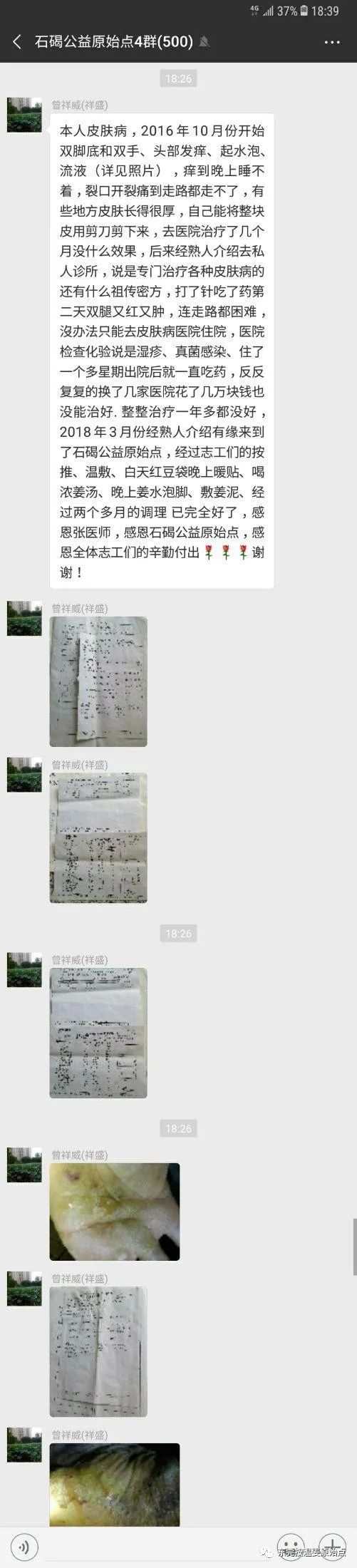 严重湿疹,真菌感染 严重湿疹,真菌感染