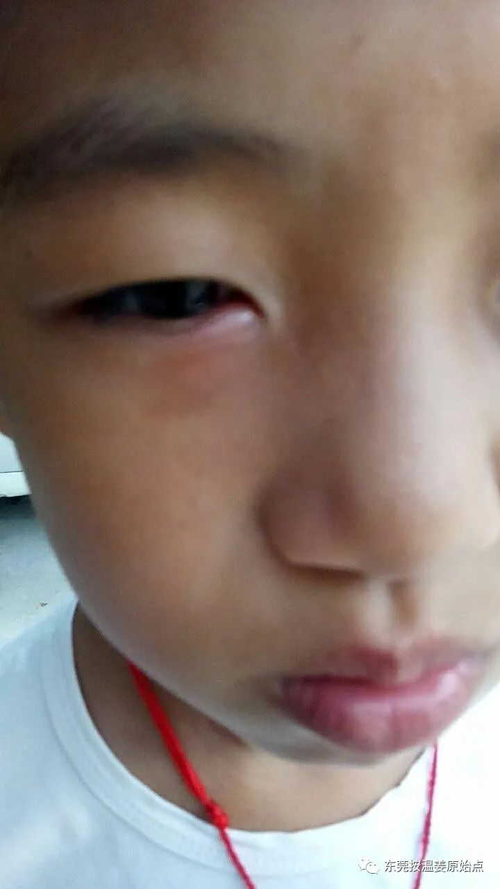 小孩眼睛红肿,耳朵痛,用原始点自己处理 小孩眼睛红肿,耳朵痛,用原始点自己处理