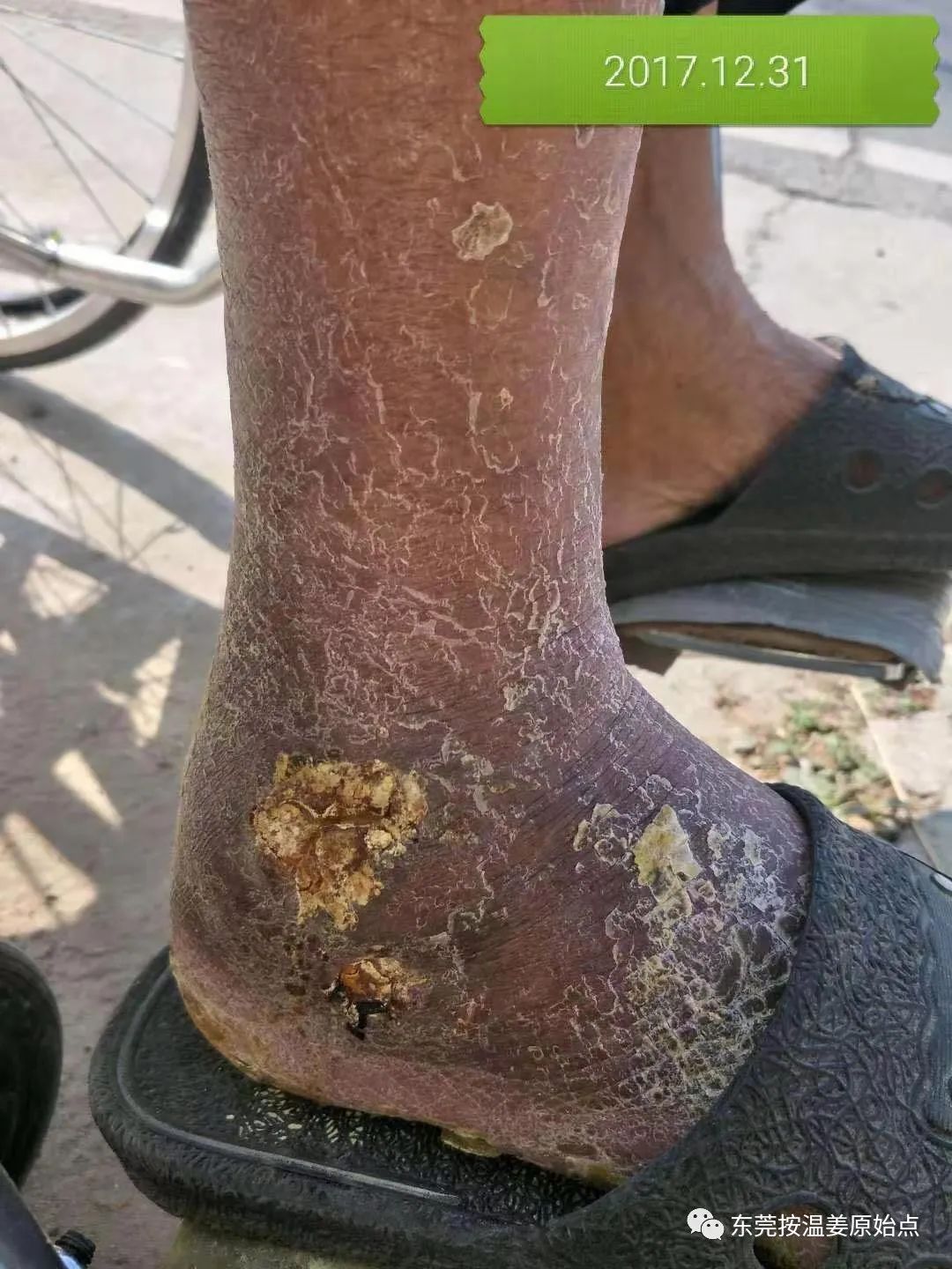 原始点让87岁中风的老爷爷免除截肢,重新行走 原始点让87岁中风的老爷爷免除截肢,重新行走