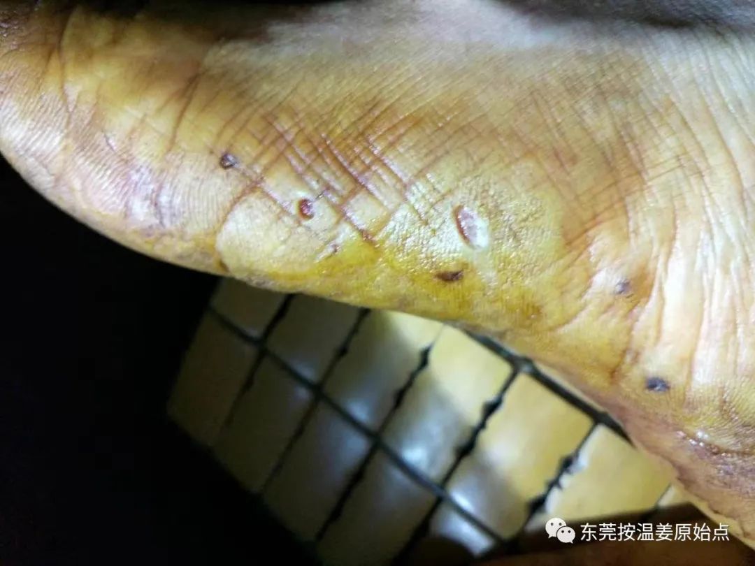 严重湿疹,真菌感染 严重湿疹,真菌感染