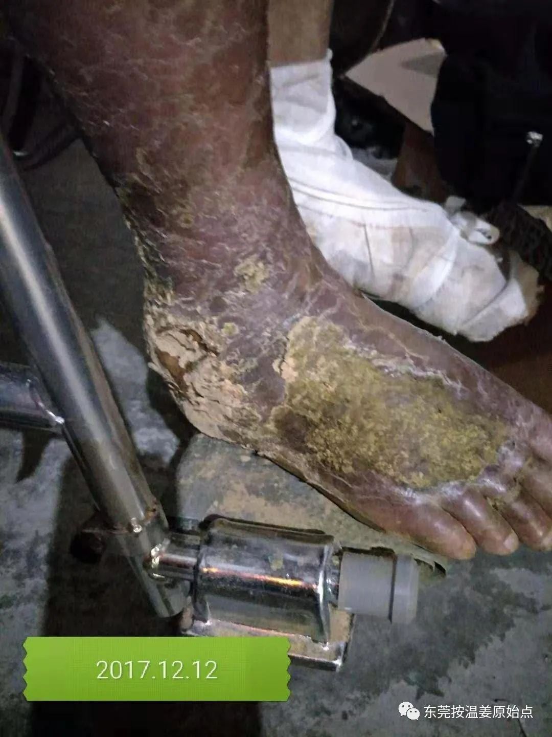 原始点让87岁中风的老爷爷免除截肢,重新行走 原始点让87岁中风的老爷爷免除截肢,重新行走