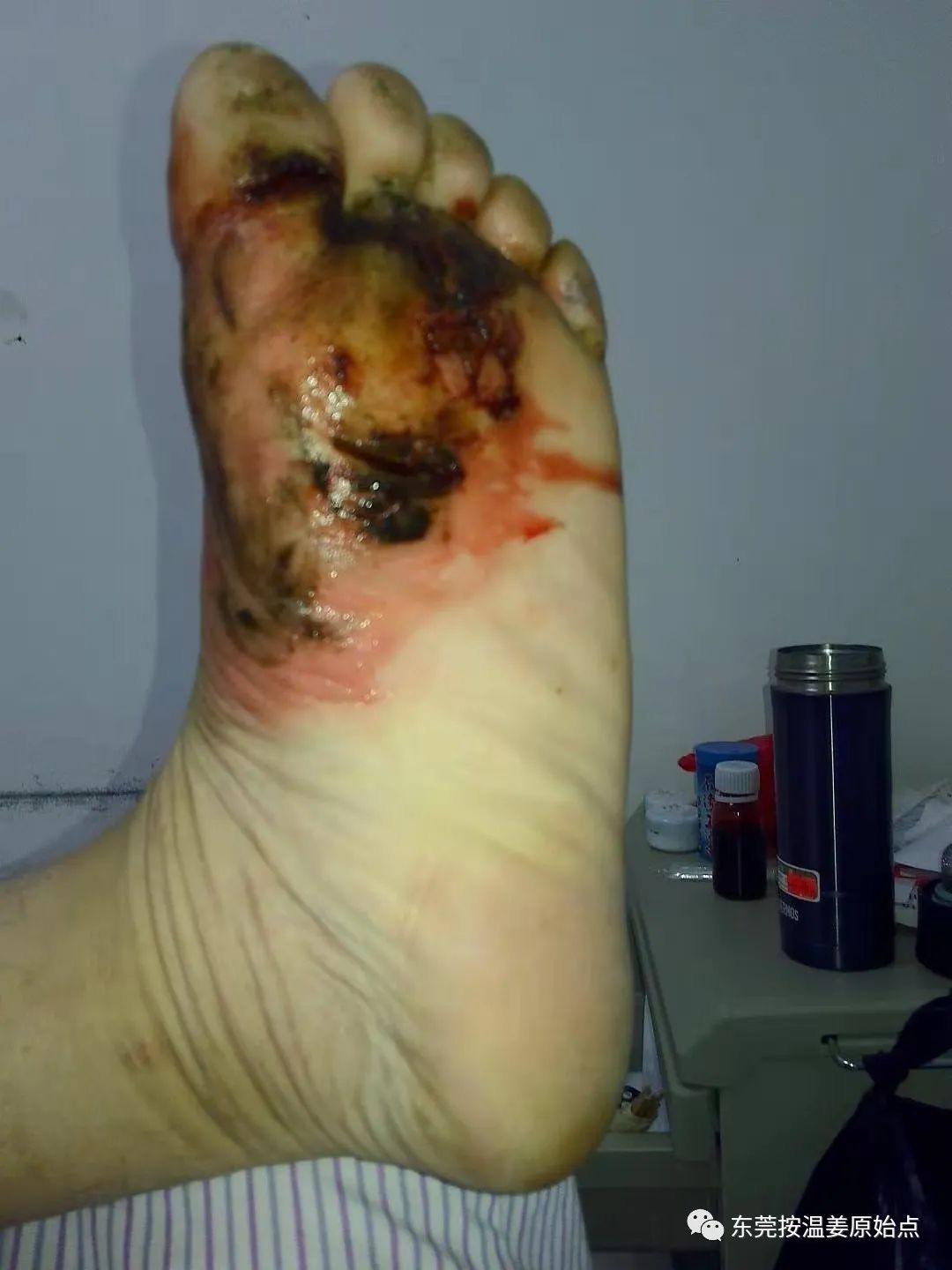 严重湿疹,真菌感染 严重湿疹,真菌感染