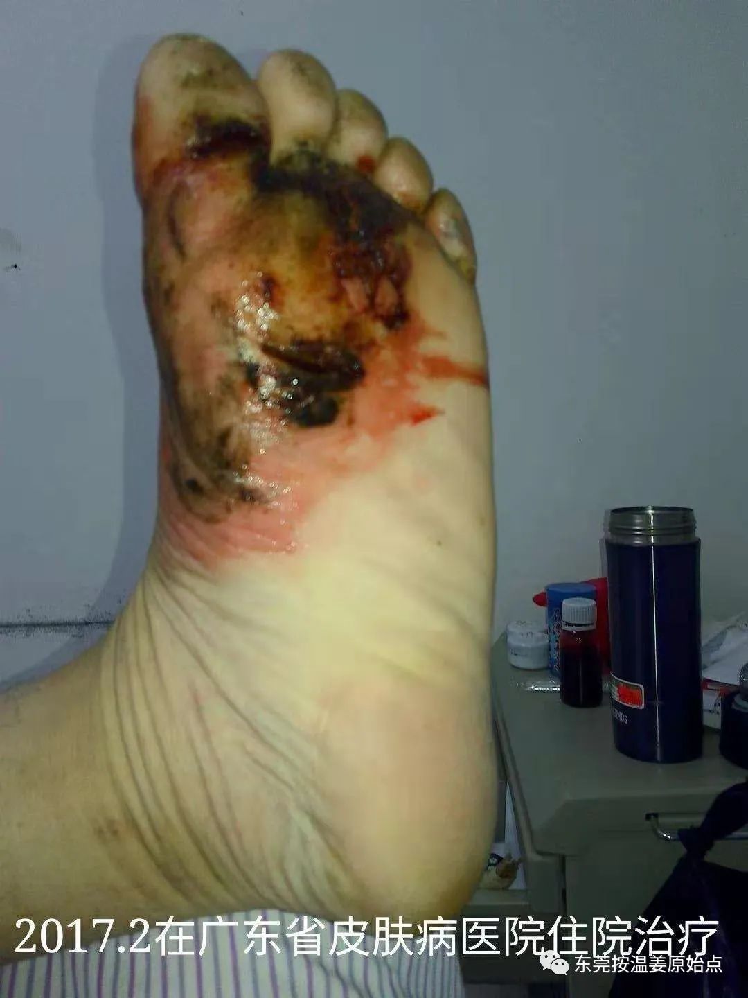 严重湿疹,真菌感染 严重湿疹,真菌感染