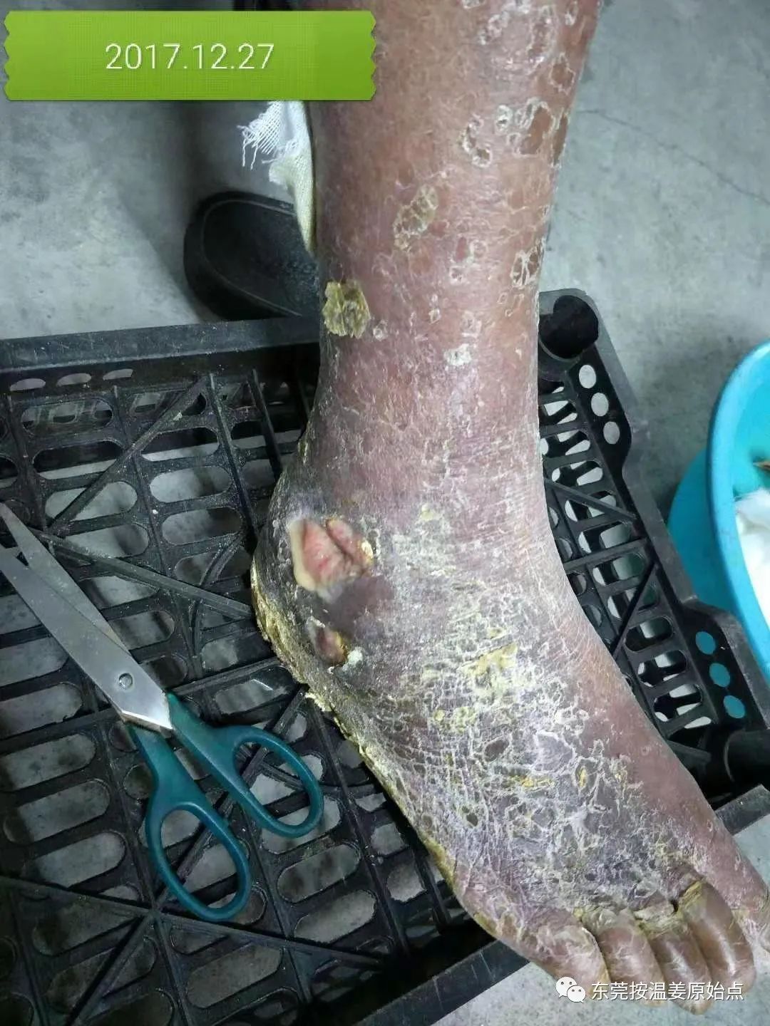 原始点让87岁中风的老爷爷免除截肢,重新行走 原始点让87岁中风的老爷爷免除截肢,重新行走