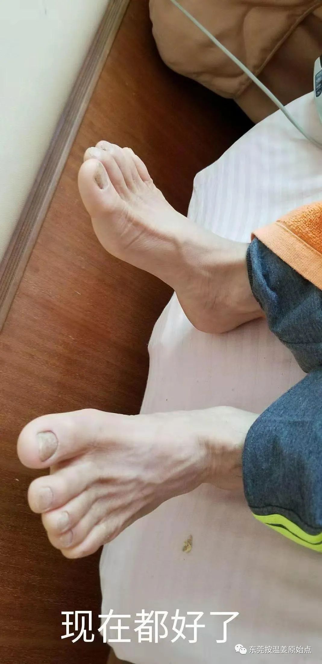 严重湿疹,真菌感染 严重湿疹,真菌感染