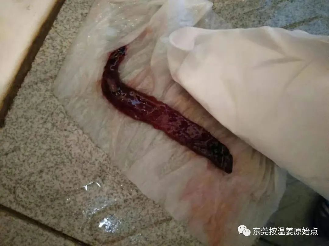 用原始点排出死胎,免除刮宫手术 用原始点排出死胎,免除刮宫手术