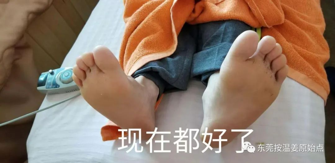 严重湿疹,真菌感染 严重湿疹,真菌感染