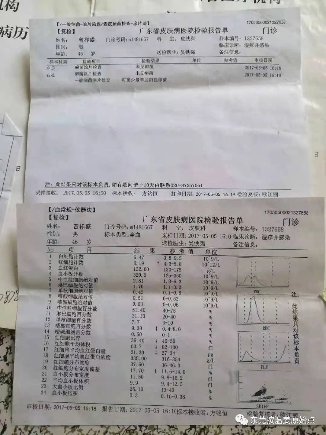 严重湿疹,真菌感染 严重湿疹,真菌感染