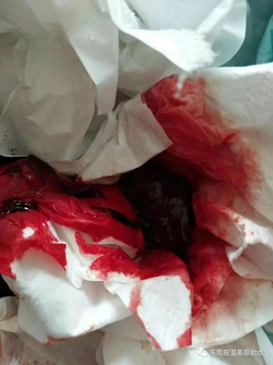 用原始点排出死胎,免除刮宫手术 用原始点排出死胎,免除刮宫手术