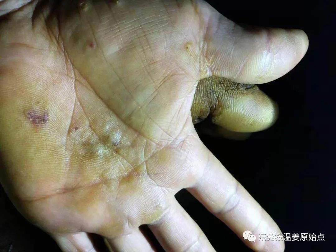 严重湿疹,真菌感染 严重湿疹,真菌感染