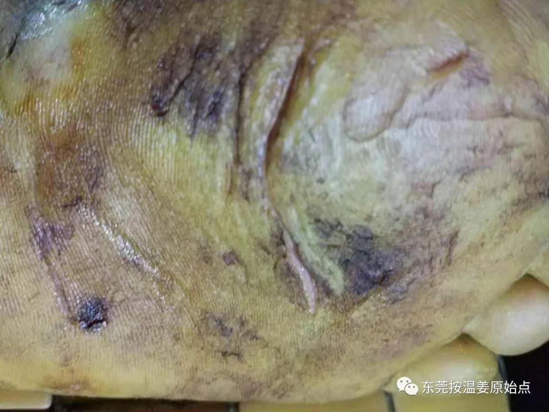 严重湿疹,真菌感染 严重湿疹,真菌感染