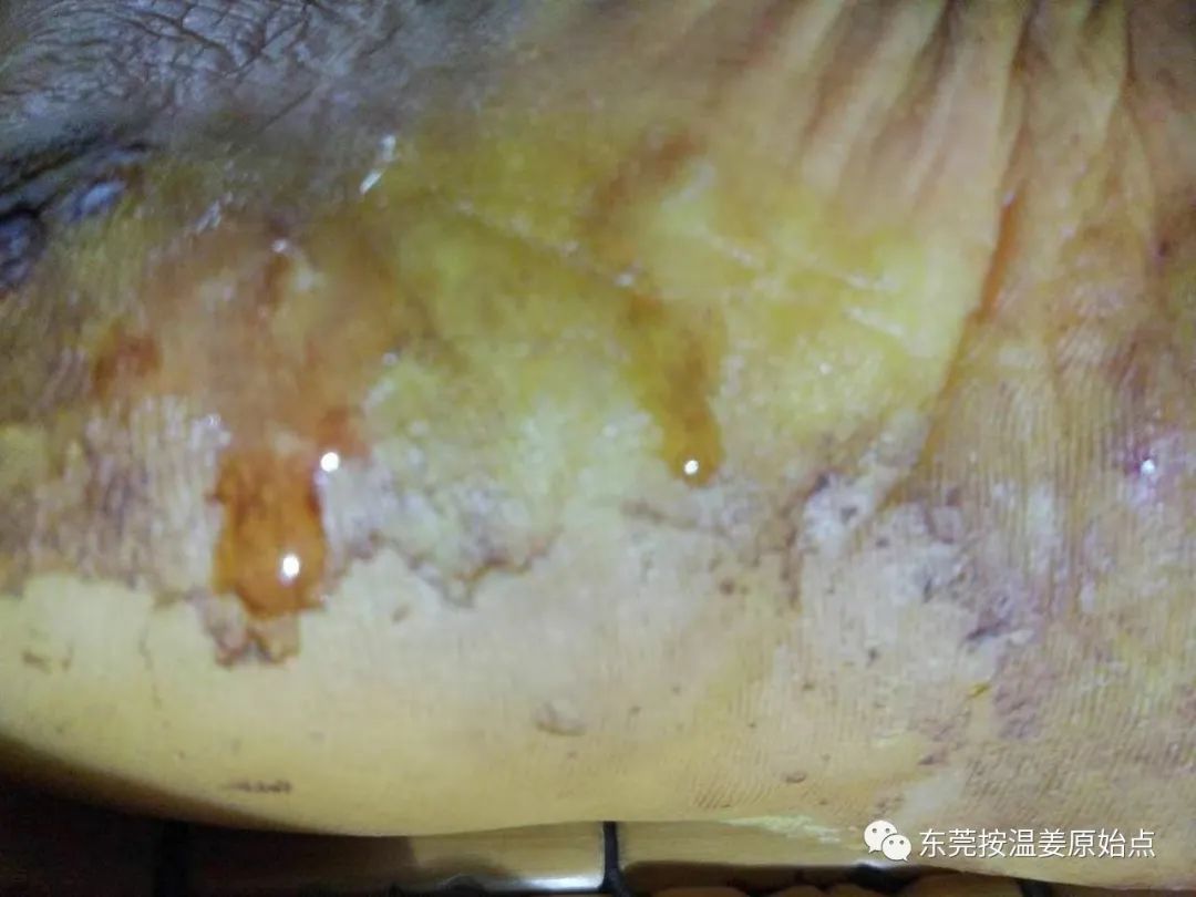 严重湿疹,真菌感染 严重湿疹,真菌感染