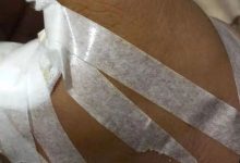 微问答221期：虎口被剪刀刺伤，去医院打了破伤风后能不能用原始点调理？-原始点全球同学网