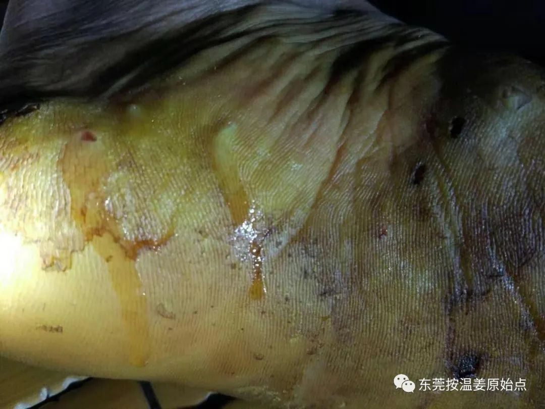 严重湿疹,真菌感染 严重湿疹,真菌感染