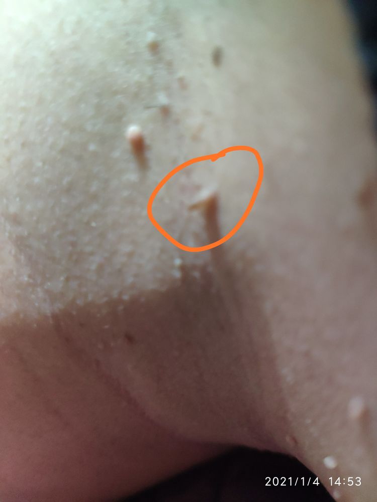 分享脖子长疣的调理,(电吹风 -热源直达患处体伤)大家可以自己试试。-原始点全球同学网