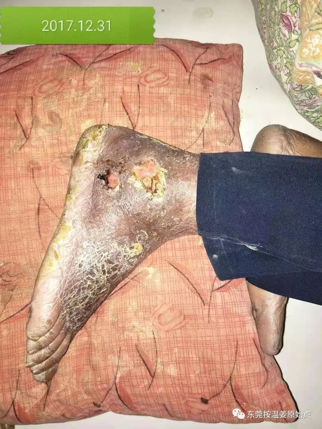 原始点让87岁中风的老爷爷免除截肢,重新行走 原始点让87岁中风的老爷爷免除截肢,重新行走