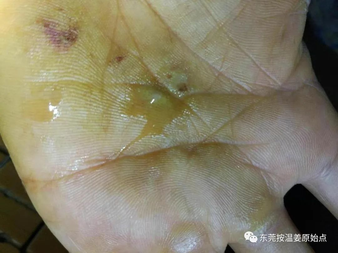 严重湿疹,真菌感染 严重湿疹,真菌感染